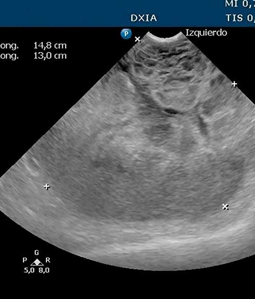 Radiografía de un tumor de bazo