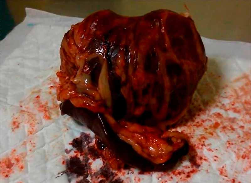 Fotografía de un tumor de bazo