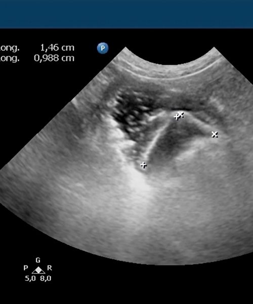 cuerpo extraño recorte 2