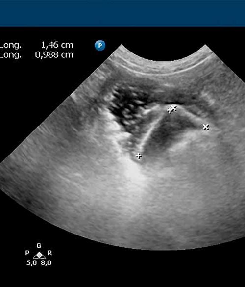 Radiografía de un cuerpo extraño/piedra