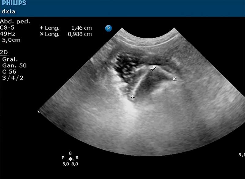Radiografía de un cuerpo extraño/piedra