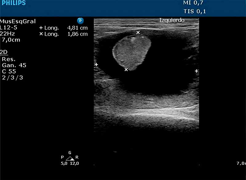 Radiografía de un Derrape perirrenal Felino