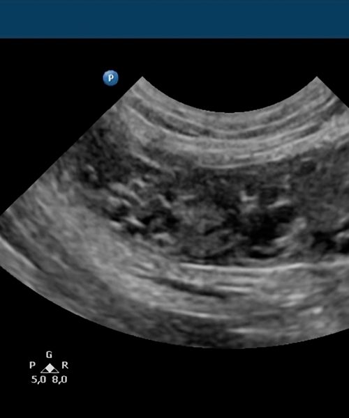 endometrisis quistica recorte 1