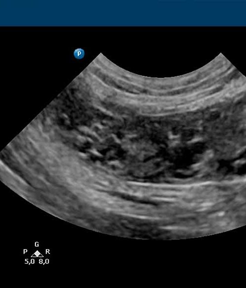 Radiografía de una endometritis quística