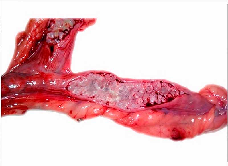 Fotografía de una endometritis quística