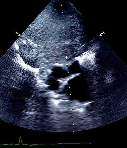 Radiografía de un de tumor ectópico de tiroides