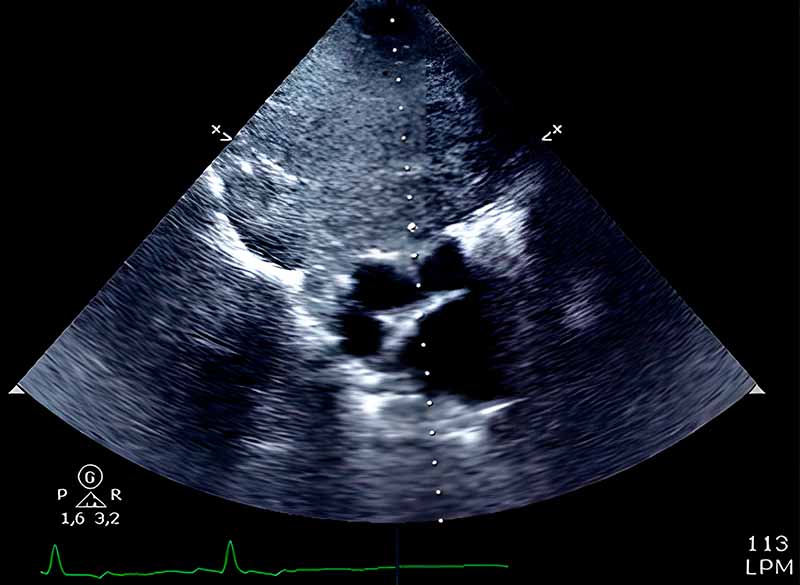 Radiografía de un de tumor ectópico de tiroides
